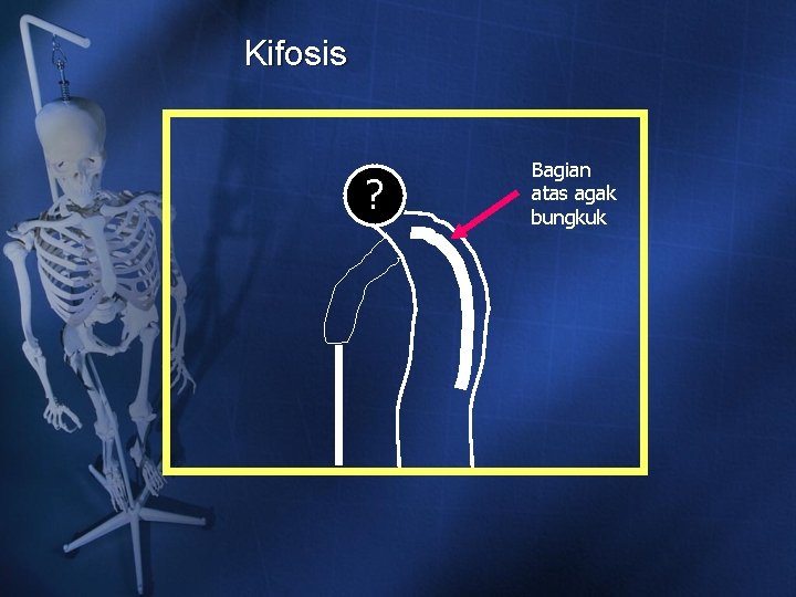Kifosis ? Bagian atas agak bungkuk Kifosis ? Bagian atas agak bungkuk