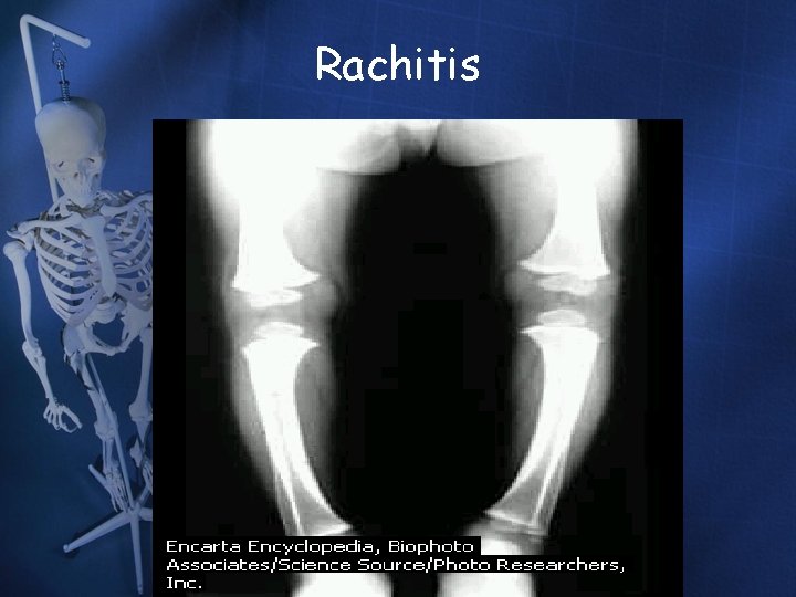 Rachitis Rachitis