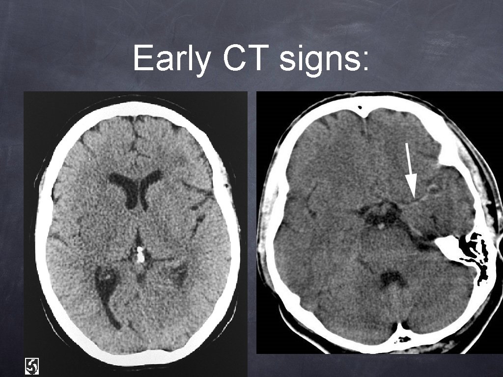 Early CT signs: Early CT signs: