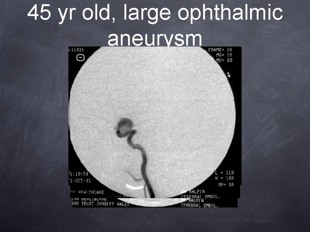 45 yr old, large ophthalmic aneurysm 45 yr old, large ophthalmic aneurysm