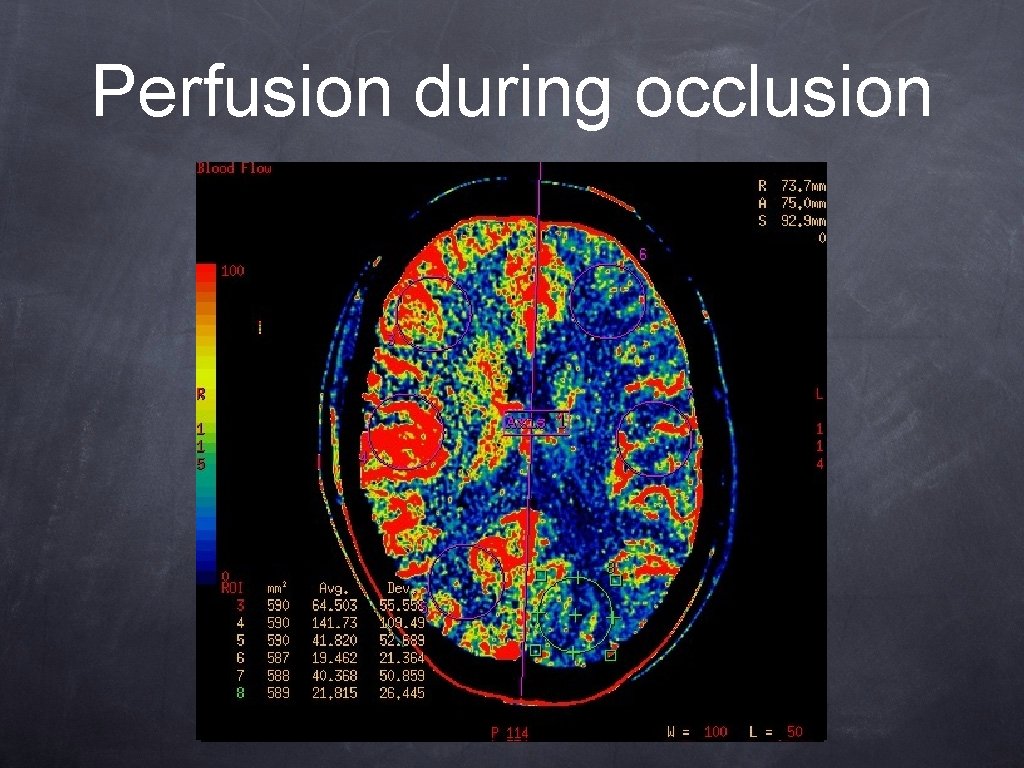 Perfusion during occlusion Perfusion during occlusion