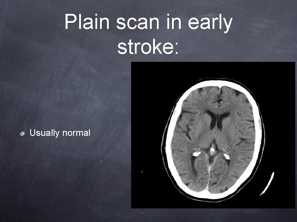 Plain scan in early stroke: Usually normal Plain scan in early stroke: Usually normal
