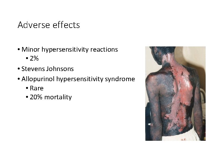 Adverse effects • Minor hypersensitivity reactions • 2% • Stevens Johnsons • Allopurinol hypersensitivity