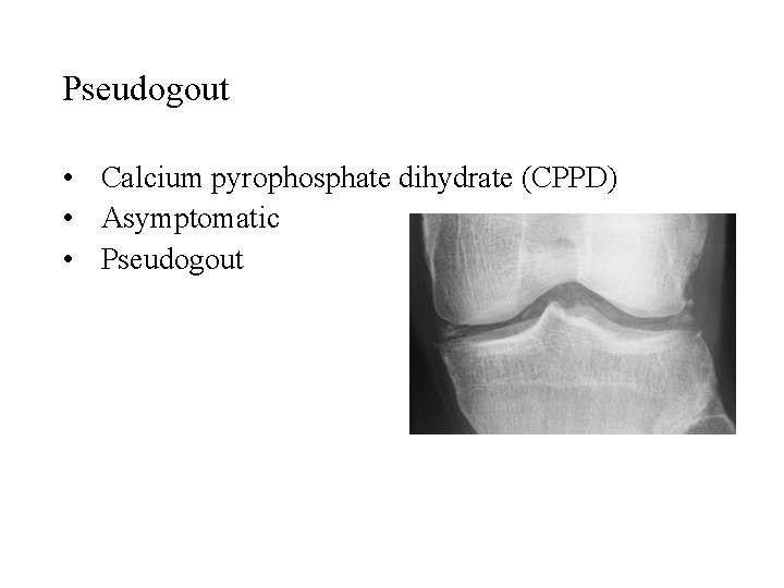 Pseudogout • Calcium pyrophosphate dihydrate (CPPD) • Asymptomatic • Pseudogout 