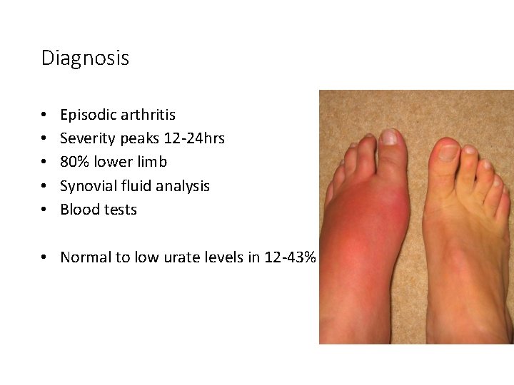 Diagnosis • • • Episodic arthritis Severity peaks 12 -24 hrs 80% lower limb