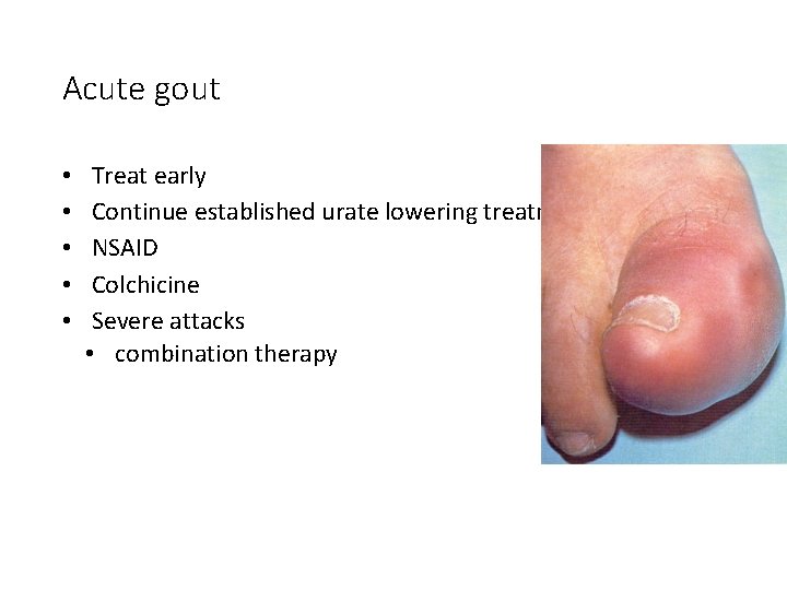 Acute gout • • • Treat early Continue established urate lowering treatment NSAID Colchicine
