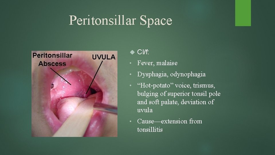 Peritonsillar Space Cl/f: • Fever, malaise • Dysphagia, odynophagia • “Hot-potato” voice, trismus, bulging