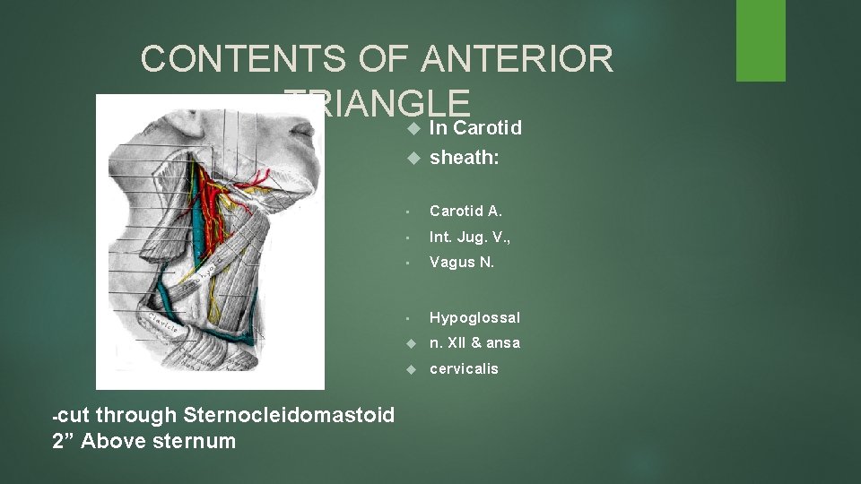 CONTENTS OF ANTERIOR TRIANGLE In Carotid -cut through Sternocleidomastoid 2” Above sternum sheath: •