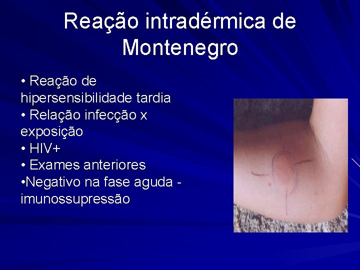Reação intradérmica de Montenegro • Reação de hipersensibilidade tardia • Relação infecção x exposição