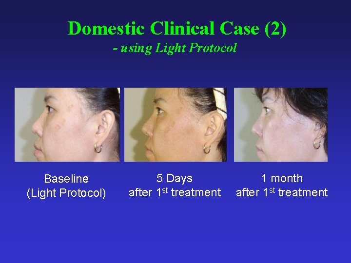 Domestic Clinical Case (2) - using Light Protocol Baseline (Light Protocol) 5 Days after