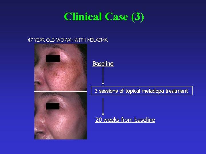Clinical Case (3) 47 YEAR OLD WOMAN WITH MELASMA Baseline 3 sessions of topical