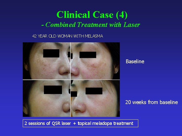 Clinical Case (4) - Combined Treatment with Laser 42 YEAR OLD WOMAN WITH MELASMA