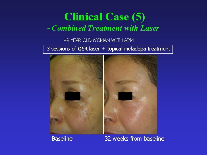 Clinical Case (5) - Combined Treatment with Laser 49 YEAR OLD WOMAN WITH ADM