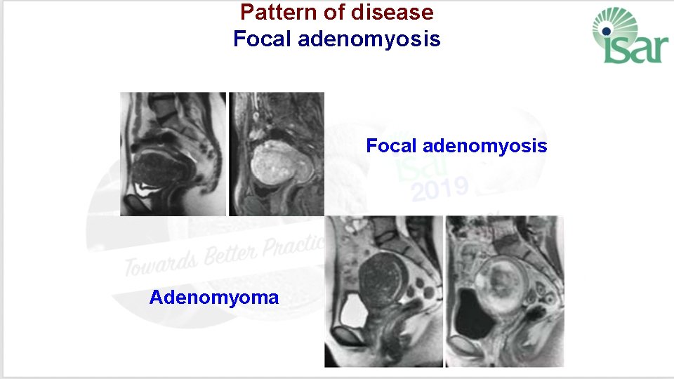 Pattern of disease Focal adenomyosis Adenomyoma 