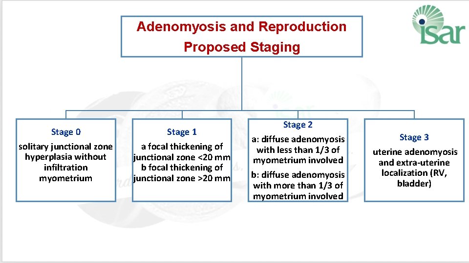 Adenomyosis and Reproduction Proposed Staging Stage 0 Stage 1 solitary junctional zone hyperplasia without