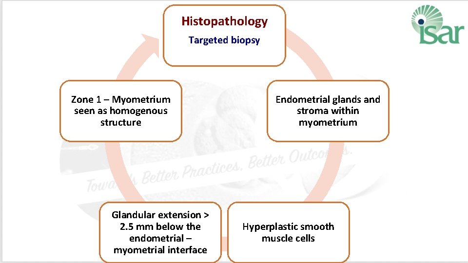 Histopathology Targeted biopsy Zone 1 – Myometrium seen as homogenous structure Glandular extension >