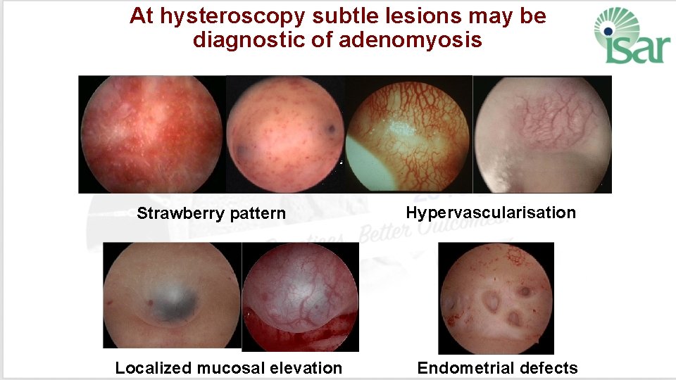 At hysteroscopy subtle lesions may be diagnostic of adenomyosis Strawberry pattern Localized mucosal elevation