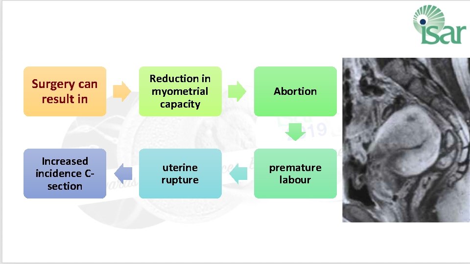 Surgery can result in Reduction in myometrial capacity Abortion Increased incidence C‐ section uterine