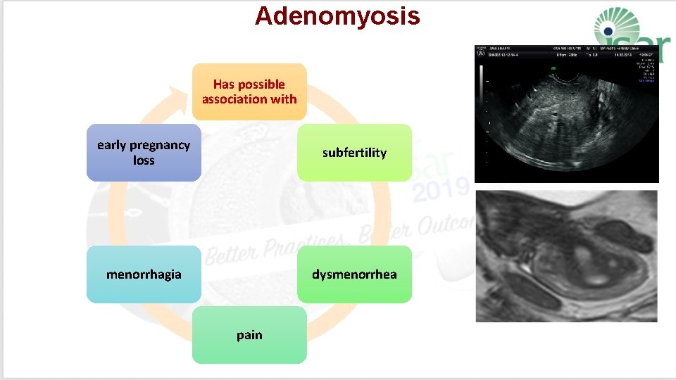 Adenomyosis Has possible association with early pregnancy loss subfertility menorrhagia dysmenorrhea pain 
