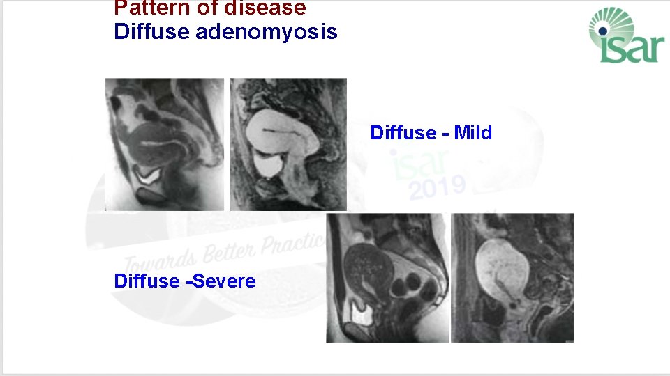 Pattern of disease Diffuse adenomyosis Diffuse - Mild Diffuse -Severe 