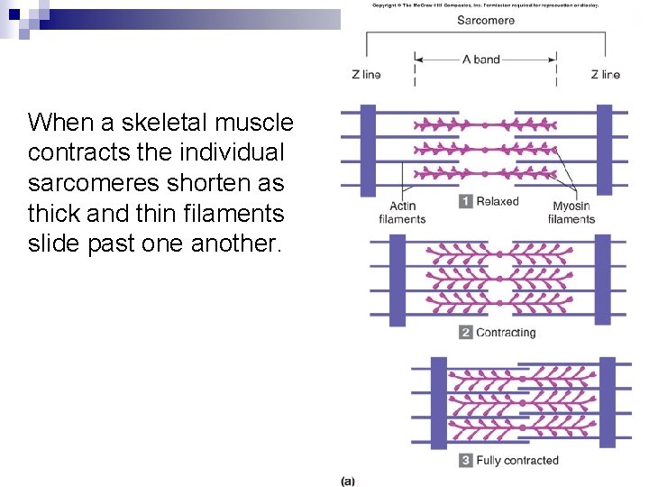 When a skeletal muscle contracts the individual sarcomeres shorten as thick and thin filaments