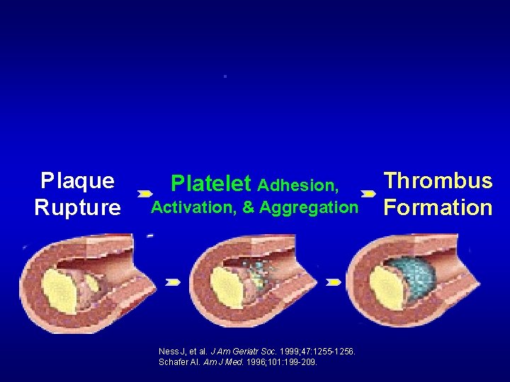 Plaque Rupture Platelet Adhesion, Activation, & Aggregation Ness J, et al. J Am Geriatr
