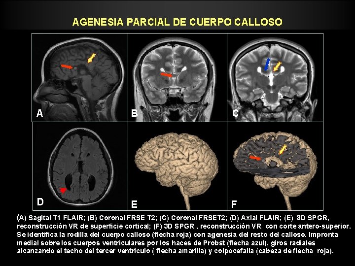 AGENESIA PARCIAL DE CUERPO CALLOSO A B C D E F (A) Sagital T