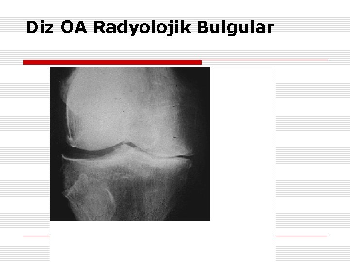 Diz OA Radyolojik Bulgular 