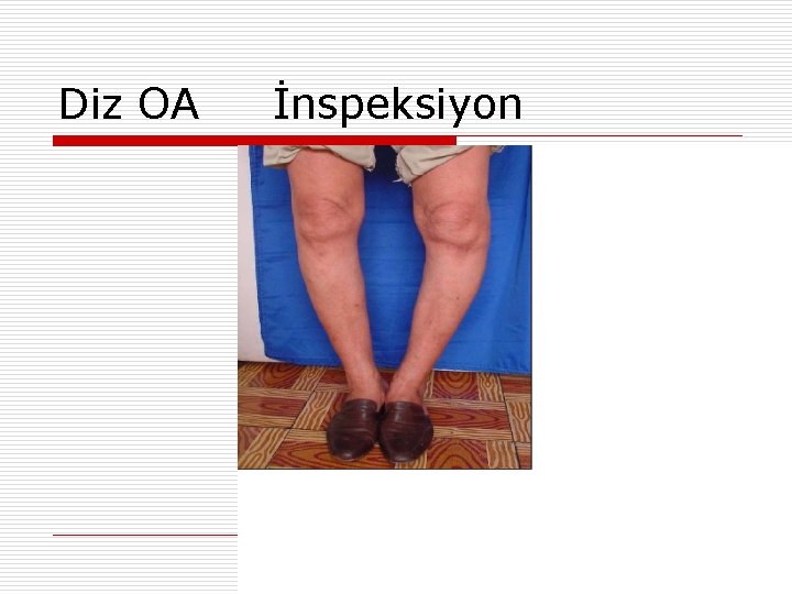 Diz OA İnspeksiyon 