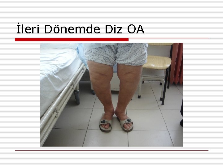 İleri Dönemde Diz OA 