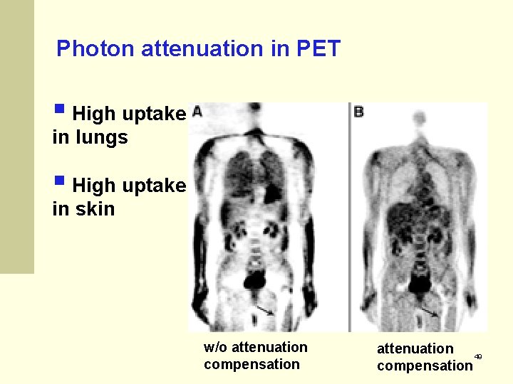 Photon attenuation in PET § High uptake in lungs § High uptake in skin