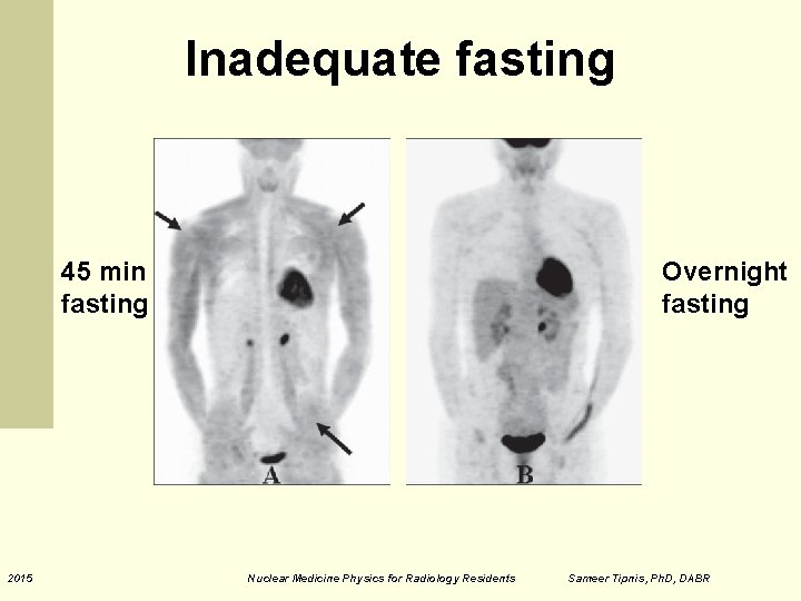 Inadequate fasting 45 min fasting 2015 Overnight fasting Nuclear Medicine Physics for Radiology Residents