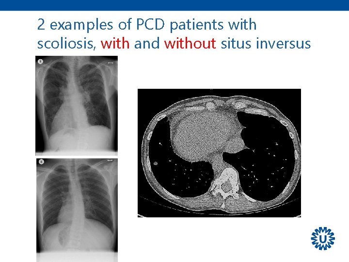 2 examples of PCD patients with scoliosis, with and without situs inversus 