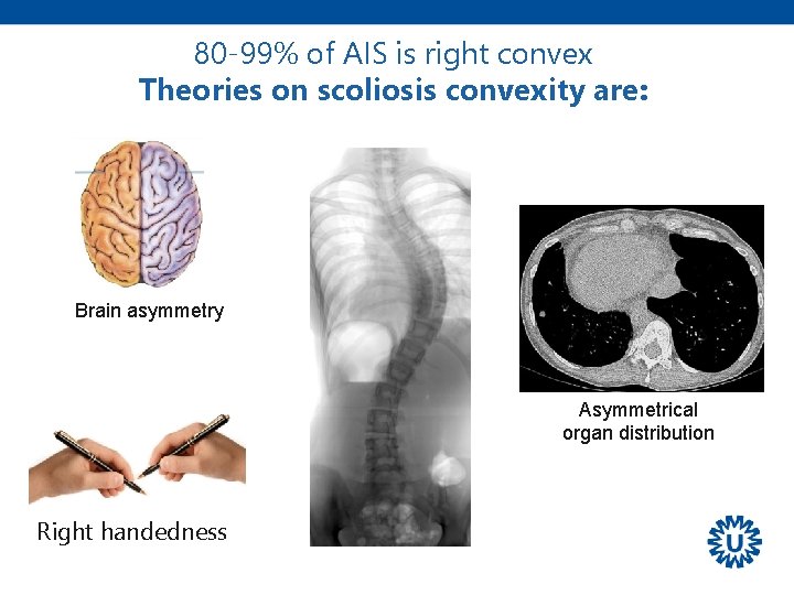 80 -99% of AIS is right convex Theories on scoliosis convexity are: Brain asymmetry