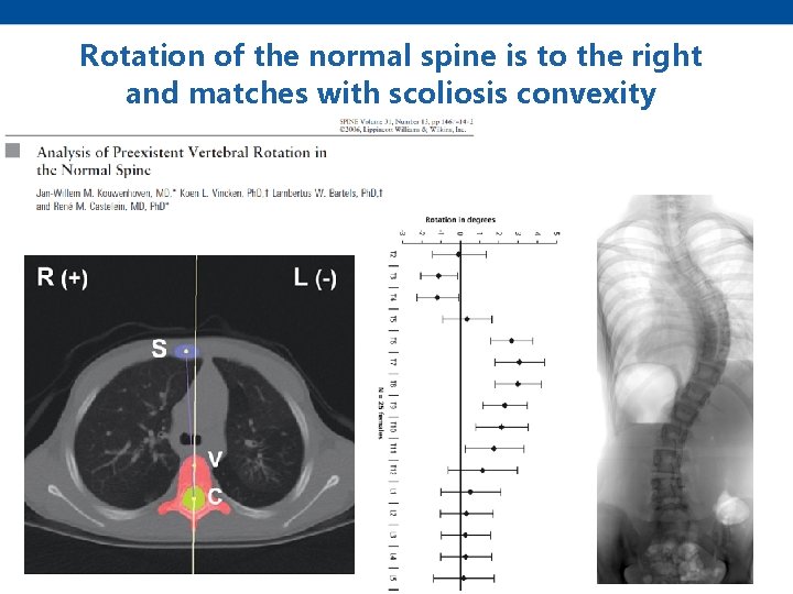 Rotation of the normal spine is to the right and matches with scoliosis convexity