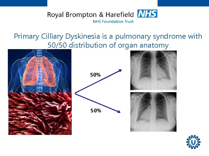 Primary Cilliary Dyskinesia is a pulmonary syndrome with 50/50 distribution of organ anatomy 50%