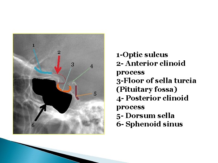 1 2 3 4 5 6 1 -Optic sulcus 2 - Anterior clinoid process