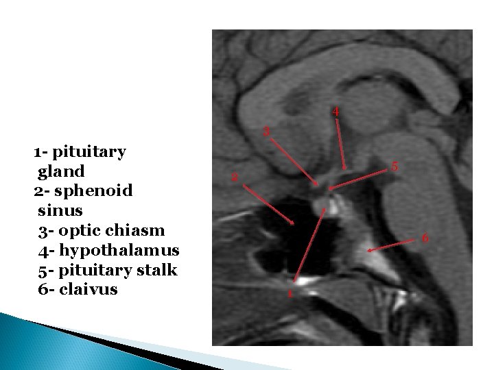 4 3 1 - pituitary gland 2 - sphenoid sinus 3 - optic chiasm