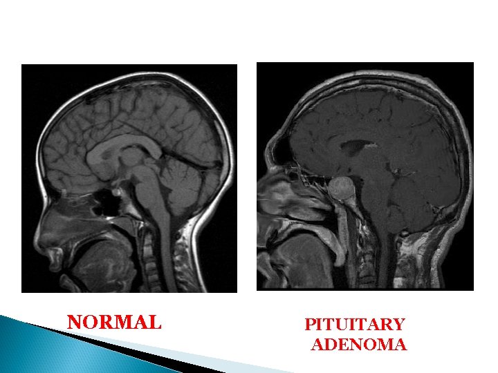 NORMAL PITUITARY ADENOMA 