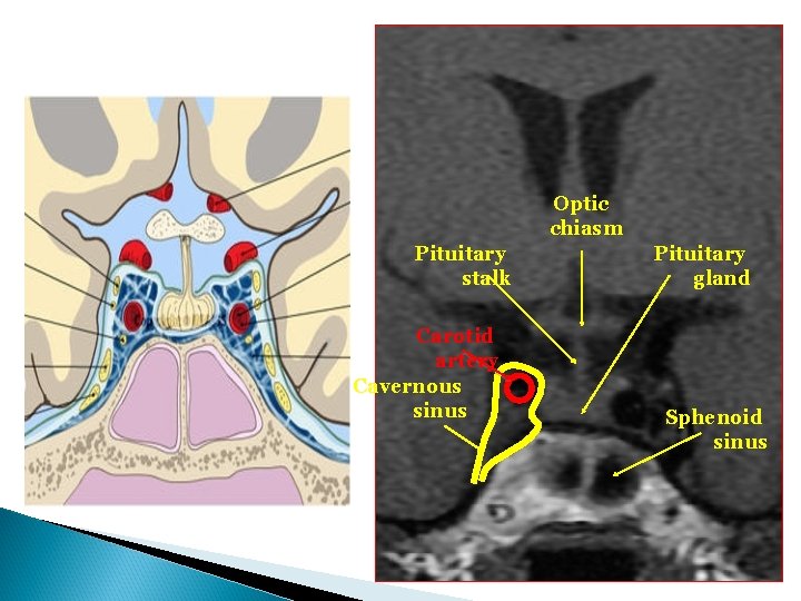 Optic chiasm Pituitary stalk Carotid artery Cavernous sinus Pituitary gland Sphenoid sinus 