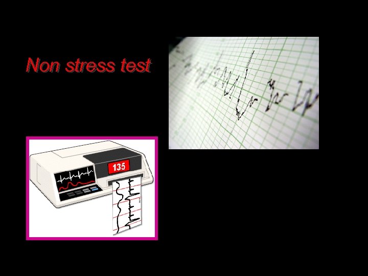 Non stress test 