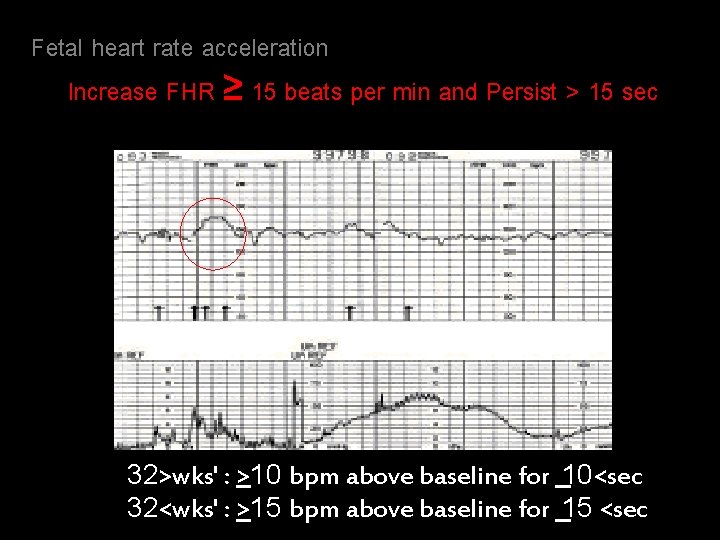 Fetal heart rate acceleration Increase FHR ≥ 15 beats per min and Persist >