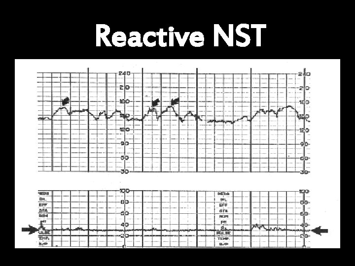 Reactive NST 