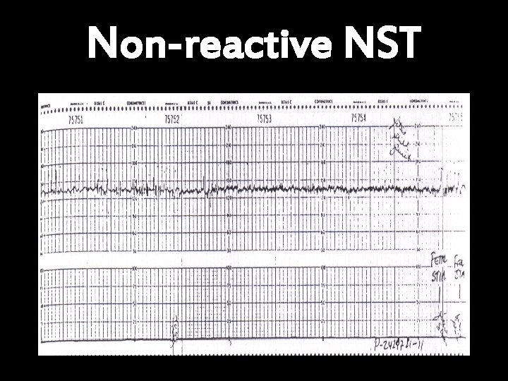 Non-reactive NST 