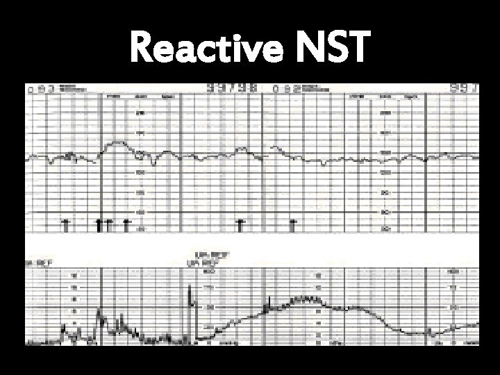 Reactive NST 
