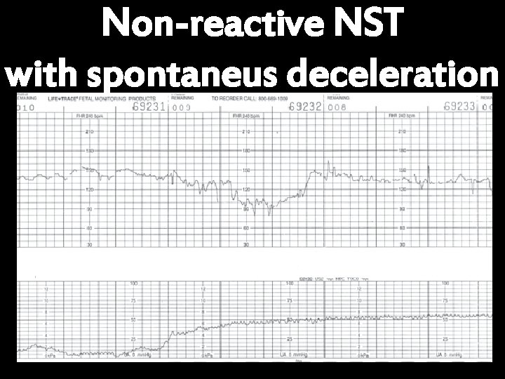 Non-reactive NST with spontaneus deceleration 
