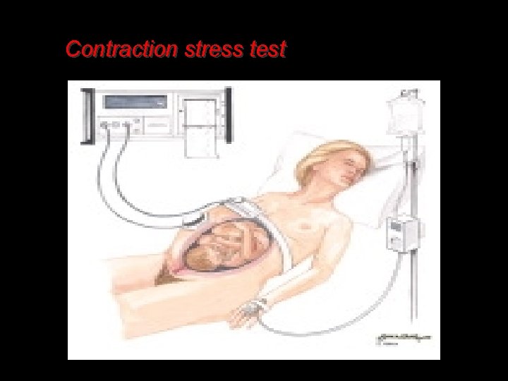 Contraction stress test 