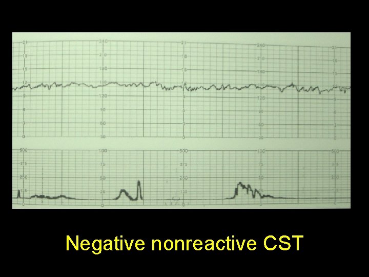 Negative nonreactive CST 