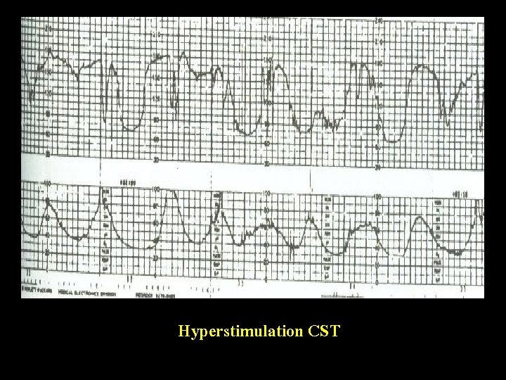 Hyperstimulation CST 