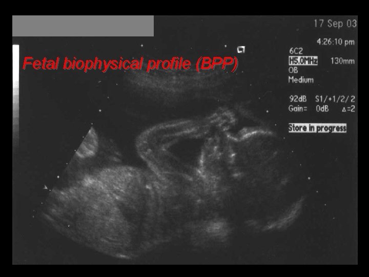 Fetal biophysical profile (BPP) 